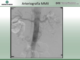 Arteriografía MMII

 
