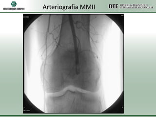 Arteriografia MMII

 