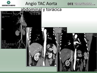 Angio TAC Aorta
abdominal y torácica

 