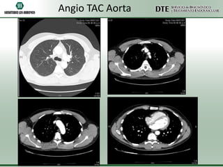 Angio TAC Aorta

 