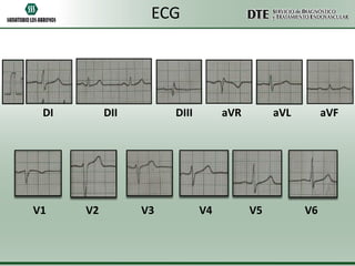 ECG

DI

V1

DII

V2

DIII

V3

aVR

V4

aVL

V5

aVF

V6

 