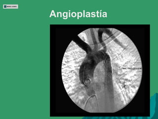 Angioplastía 