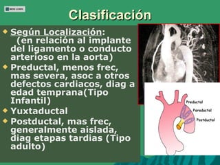 <ul><li>Según Localización :  (en relación al implante del ligamento o conducto arterioso en la aorta) </li></ul><ul><li>P...