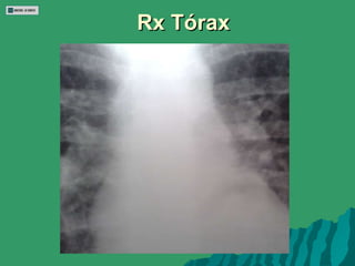Rx Tórax 