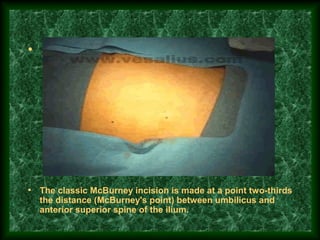 •
• The classic McBurney incision is made at a point two-thirds
the distance (McBurney's point) between umbilicus and
anterior superior spine of the ilium.
 