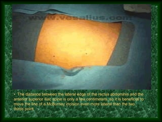 • The distance between the lateral edge of the rectus abdominis and the
anterior superior iliac spine is only a few centimeters, so it is beneficial to
move the line of a McBurney incision even more lateral than the two
thirds point
 