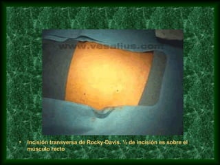 • Incisión transversa de Rocky-Davis. ½ de incisión es sobre el
músculo recto
 