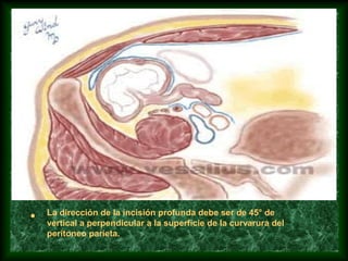 • La dirección de la incisión profunda debe ser de 45° de
vertical a perpendicular a la superficie de la curvarura del
peritoneo parieta.
 