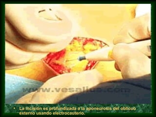 • La incisión es profundizada a la aponeurosis del oblicuo
externo usando electrocauterio.
 