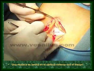• Una muesca es hecha en el oblicuo externo con el bisturí.
 