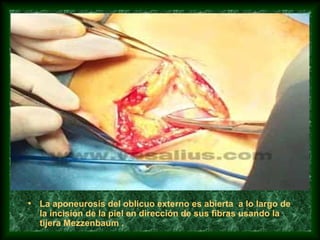 • La aponeurosis del oblicuo externo es abierta a lo largo de
la incisión de la piel en dirección de sus fibras usando la
tijera Mezzenbaum .
 