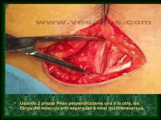 • Usando 2 pinzas Pean perpendiculares una a la otra, las
fibras del músculo son separadas a nivel del ttransversus.
 