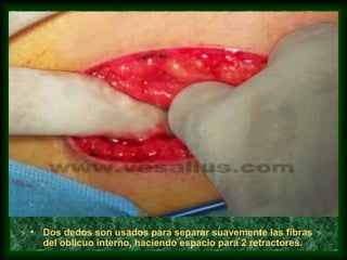 • Dos dedos son usados para separar suavemente las fibras
del oblicuo interno, haciendo espacio para 2 retractores.
 