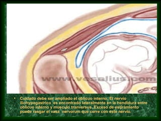 • Cuidado debe ser ampliado el oblicuo interno. El nervio
iliohypogastrico es encontrado lateralmente en la hendidura entre
oblicuo interno y musculo tranversus. Exceso de estiramiento
puede rasgar el vasa nervorum que corre con este nervio.
 