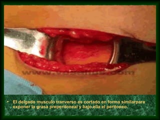 • El delgado musculo tranverso es cortado en forma similarpara
exponer la grasa preperitoneal y bajo ella el peritoneo.
 