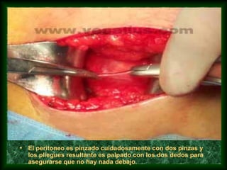 • El peritoneo es pinzado cuidadosamente con dos pinzas y
los pliegues resultante es palpado con los dos dedos para
asegurarse que no hay nada debajo.
 