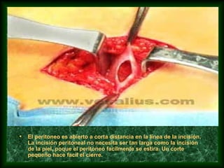 • El peritoneo es abierto a corta distancia en la línea de la incisión.
La incisión peritoneal no necesita ser tan larga como la incisión
de la piel, poque el peritoneo facilmente se estira. Un corte
pequeño hace facil el cierre.
 