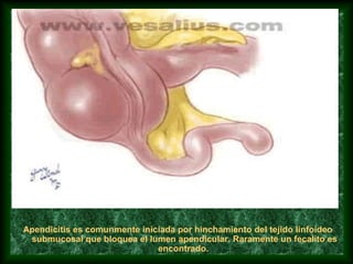 Apendicitis es comunmente iniciada por hinchamiento del tejido linfoideo
submucosal que bloquea el lumen apendicular. Raramente un fecalito es
encontrado.
 