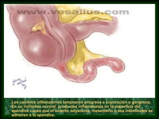 Los cambios inflamatorios tempranos progresa a supuración o gangrena.
En un individuo normal, productos inflamatorios en la superficie del
apendice causa que el omento adyacente, mesenterio o asa intestinales se
adhieren a la apendice.
 
