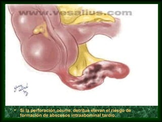 • Si la perforación ocurre, detritus elevan el riesgo de
formación de abscesos intraabominal tardio.
 