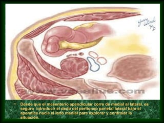 • Desde que el mesenterio apendicular corre de medial al lateral, es
seguro introducir el dedo del peritoneo parietal lateral bajo el
apendice hacia el lado medial para explorar y controlar la
situación.
 