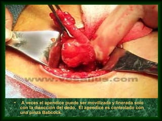 • A veces el apendice puede ser movilizada y linerada solo
con la disección del dedo. El apendice es controlado con
una pinza Babcock.
 
