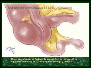 • Sie el apendice no es facilmente accesible o es retrocecal, la
siguiente maniobra es para identificar el ciego y la tenia.
 