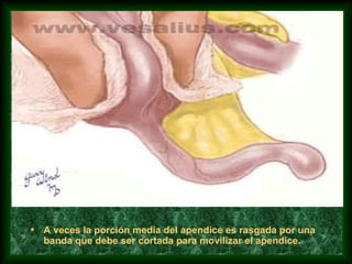 • A veces la porción media del apendice es rasgada por una
banda que debe ser cortada para movilizar el apendice.
 