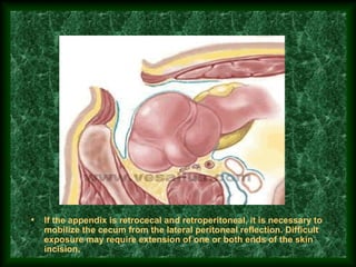 • If the appendix is retrocecal and retroperitoneal, it is necessary to
mobilize the cecum from the lateral peritoneal reflection. Difficult
exposure may require extension of one or both ends of the skin
incision.
 