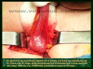 • El apendice es movilizado dentro de la herida y la base es visualizada en
su unión con el ciego. Esta esxposición es alcanzada con suave tracción
del ciego. Debido a su friabilidad, jalada para exponer la base.
 