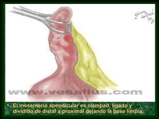 • El mesenterio apendicular es clampad, ligado y
dividido de distal a proximal dejando la base limpia.
 