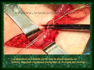 • La apendice es cortada junto con la pinza usando un
bisturí. Algunos cirujanos cauterizan la mucosa del muñon.
 