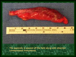• The appendix is passed off the field along with attached
contaminated instruments.
 