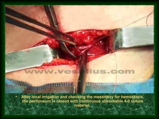 • After local irrigation and checking the mesentery for hemostasis,
the peritoneum is closed with continuous absorbable 4-0 suture
material.
 