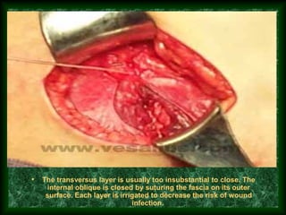 • The transversus layer is usually too insubstantial to close. The
internal oblique is closed by suturing the fascia on its outer
surface. Each layer is irrigated to decrease the risk of wound
infection.
 
