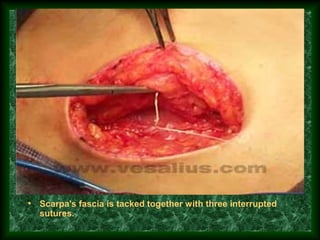 • Scarpa's fascia is tacked together with three interrupted
sutures.
 