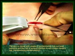• The skin is closed with staples if contamination has not been
excesiva and the risk of wound infection is not a major concern
(eg. immunocompromised patient).
 