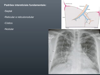 Padrões intersticiais fundamentais:
-Septal
-Reticular e reticulonodular
-Cístico
-Nodular