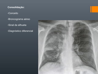 Consolidação:
-Conceito
-Broncograma aéreo
-Sinal da silhueta
-Diagnóstico diferencial