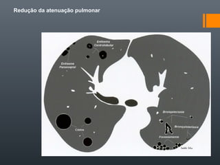 Redução da atenuação pulmonar