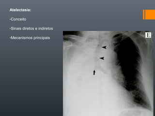 Atelectasia:
-Conceito
-Sinais diretos e indiretos
-Mecanismos principais