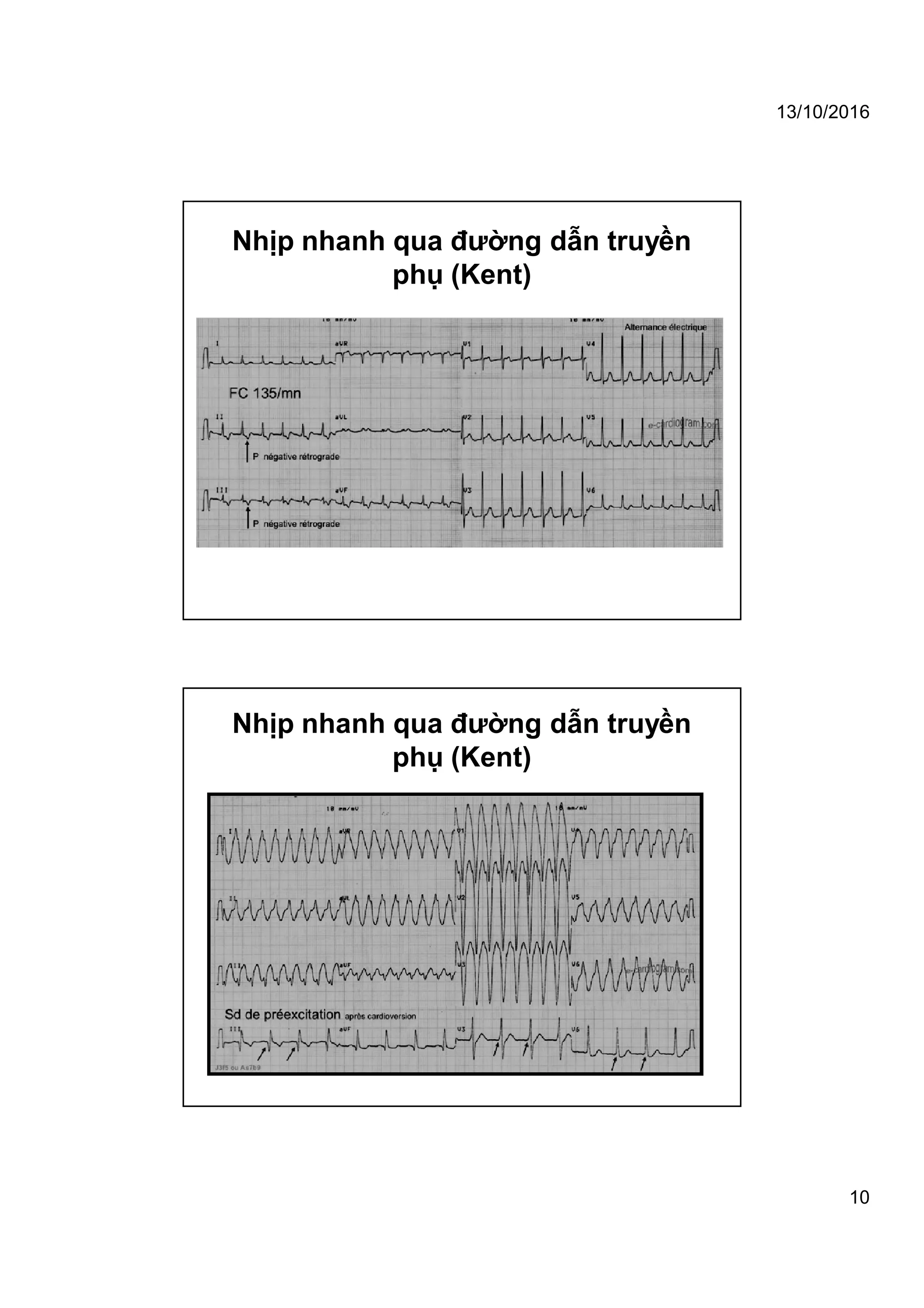 13/10/2016
10
Nhịp nhanh qua đường dẫn truyền
phụ (Kent)
Nhịp nhanh qua đường dẫn truyền
phụ (Kent)
 