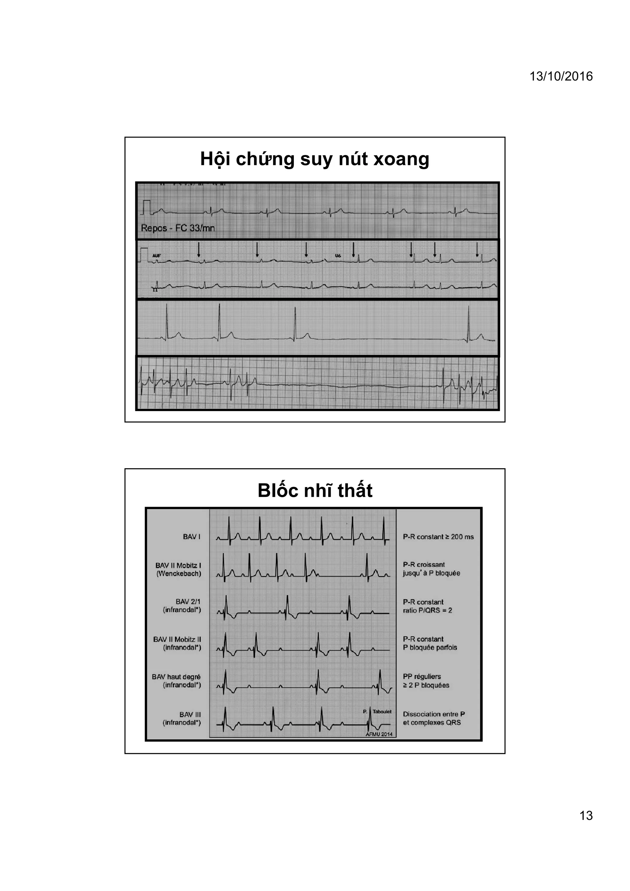 13/10/2016
13
Hội chứng suy nút xoang
Blốc nhĩ thất
 