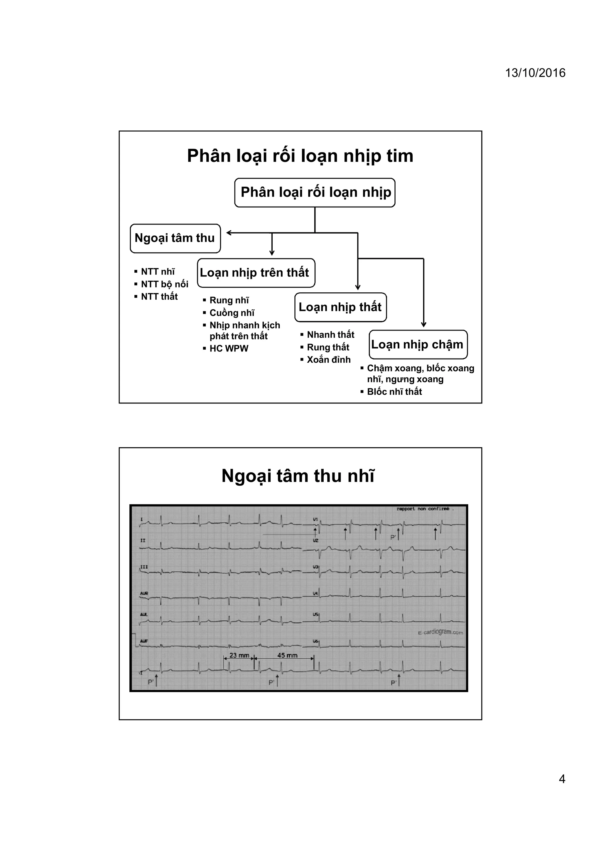 13/10/2016
4
Phân loại rối loạn nhịp tim
Phân loại rối loạn nhịp
Loạn nhịp thất
Loạn nhịp chậm
Ngoại tâm thu
Loạn nhịp trên thất NTT nhĩ
 NTT bộ nối
 NTT thất  Rung nhĩ
 Cuồng nhĩ
 Nhịp nhanh kịch
phát trên thất
 HC WPW
 Nhanh thất
 Rung thất
 Xoắn đỉnh
 Chậm xoang, blốc xoang
nhĩ, ngưng xoang
 Blốc nhĩ thất
Ngoại tâm thu nhĩ
 