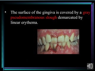 Comprehensive Overview of Acute Necrotizing Ulcerative Gingivitis (ANUG ...