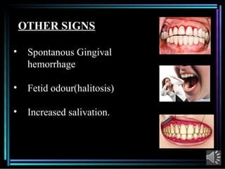 Comprehensive Overview of Acute Necrotizing Ulcerative Gingivitis (ANUG ...