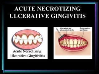 Comprehensive Overview of Acute Necrotizing Ulcerative Gingivitis (ANUG ...
