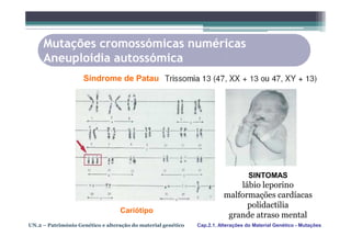 Mutações cromossómicas numéricas
     Aneuploidia autossómica
                    Síndrome de Patau




                                                                                   SINTOMAS
                                                                            lábio leporino
                                                                        malformações cardíacas
                                                                              polidactilia
                                  Cariótipo
                                                                         grande atraso mental
UN.2 – Património Genético e alteração do material genético   Cap.2.1. Alterações do Material Genético - Mutações
 