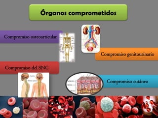 Órganos comprometidos
Compromiso osteoarticular
Compromiso del SNC
Compromiso genitourinario
Compromiso cutáneo
 