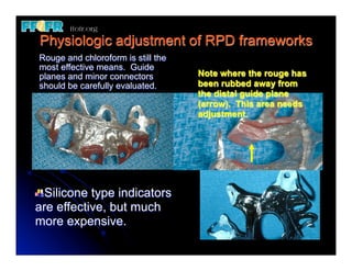 Guide Plane Rpd Sample 24.(new)mfp defects and rpd design | PDF